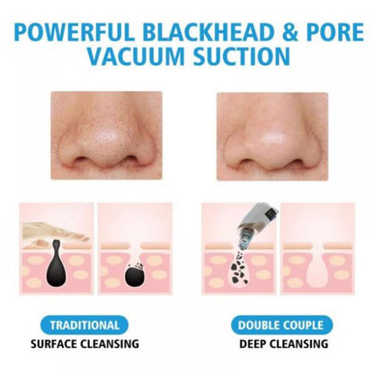 Facial Blackhead Remover - Dead Skin Acne Remover - Blackhead Sucking Machine